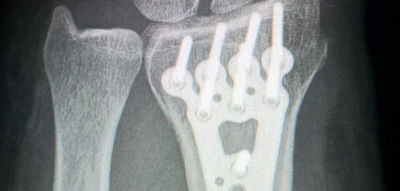 Processing of bone screws and anchors
