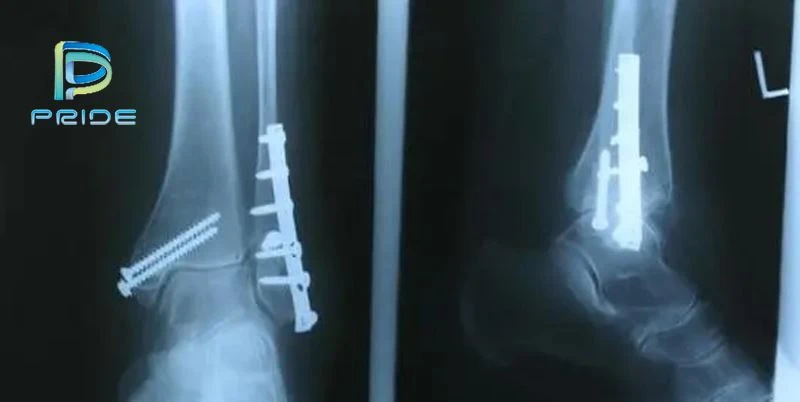 The basic structure of bone screws