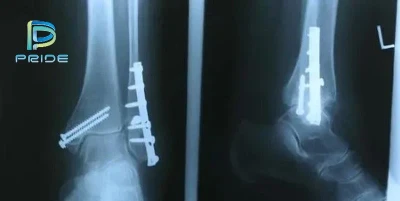 The basic structure of bone screws