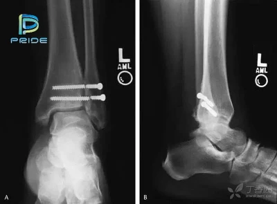 Why bone screws