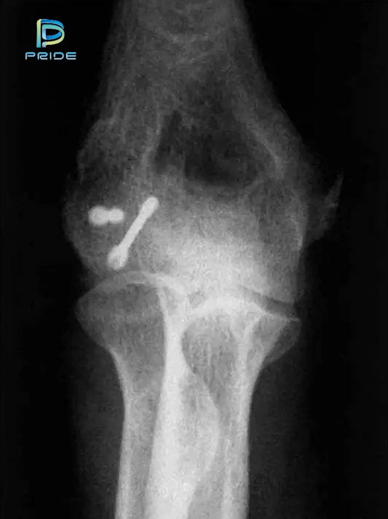 Other variables in bone screw design