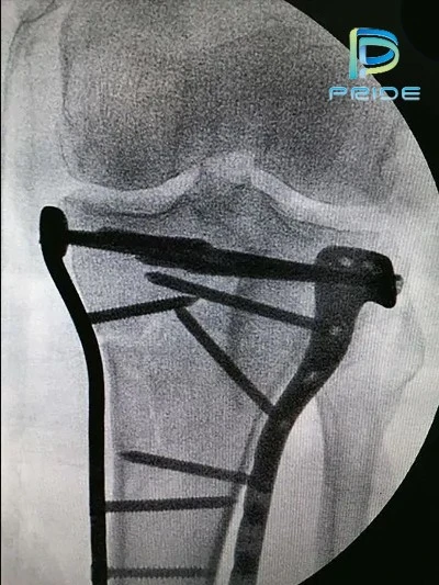 Specific material considerations for bone screws