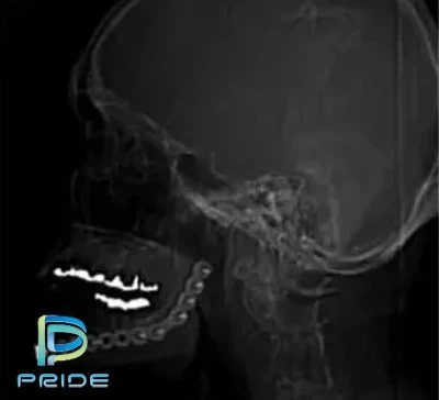 Pride Processing vs. 3D laser printing of bone screws?
